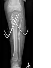Figure 2: Postoperative image demonstrating correction after osteotomies of the tibia and fibula to realign the limb, fixed with percutaneous pins. 