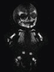 skeletal dysplasia CT