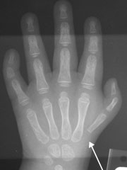 Thumb Hypoplasia with missing carpometacarpal joint