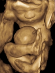 ultrasound 3D fetal mri