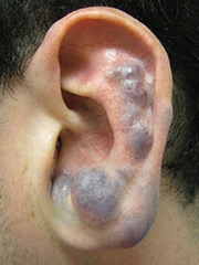 Blue Rubber Bleb Nevus Syndrome Image