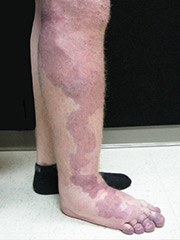 Klippel Trenaunay Syndrome Image