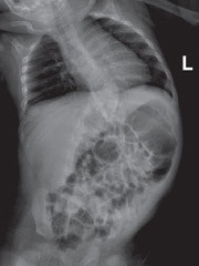 X-ray showing congenital scoliosis in 4-month-old