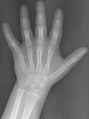 X-ray Hand Image