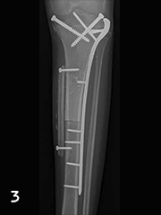 Post-surgery X-ray of the tibia
