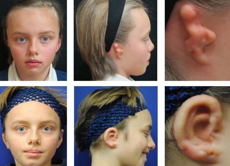Ear reconstruction using rib graft