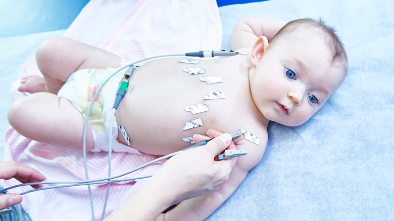 ECG leads being placed on baby