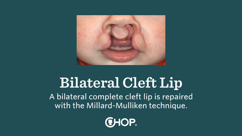 Bilateral Cleft Lip Education Slide 01