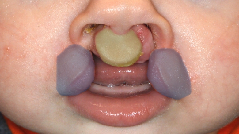 Bilateral Cleft Lip Education Slide 03