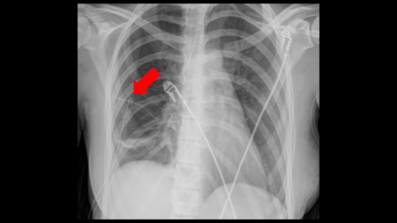 Collapsed Lung Re-Expanded X-ray Image