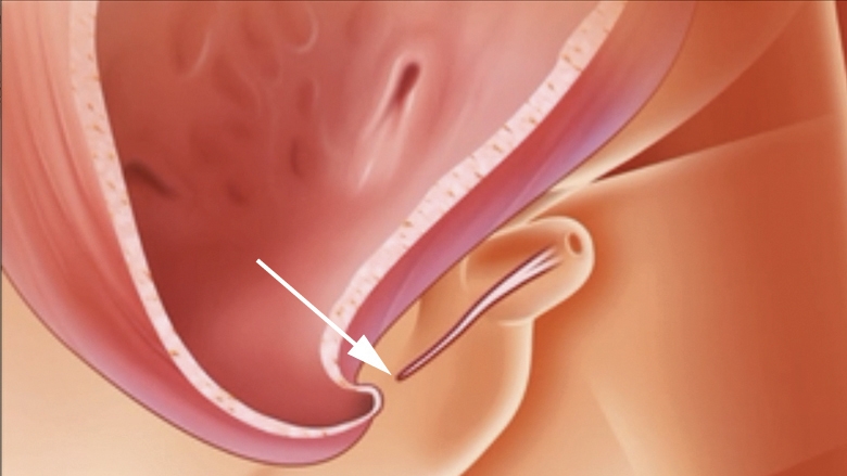 Illustration of Urethral atresia (UA), a complete obstruction of the urethra, can cause LUTO