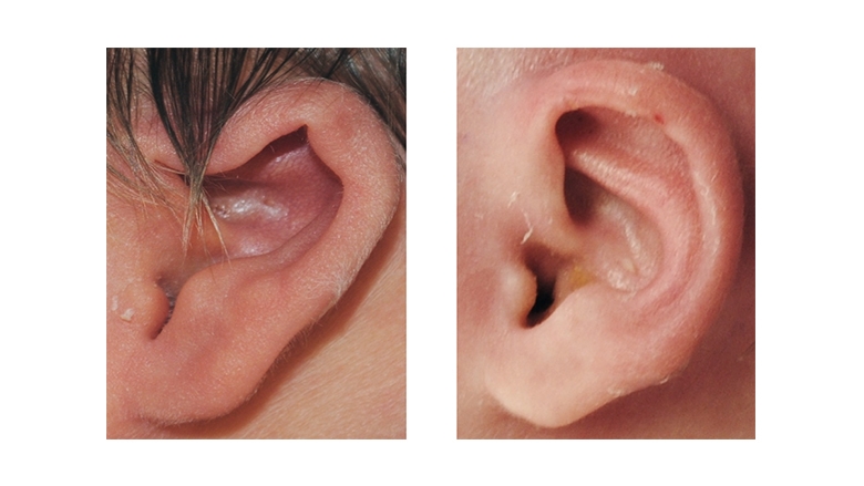 Stahl's Ear Deformity before and after Ear Molding