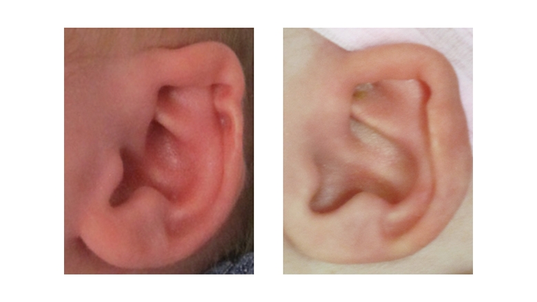 Combination ear deformity before and after ear molding