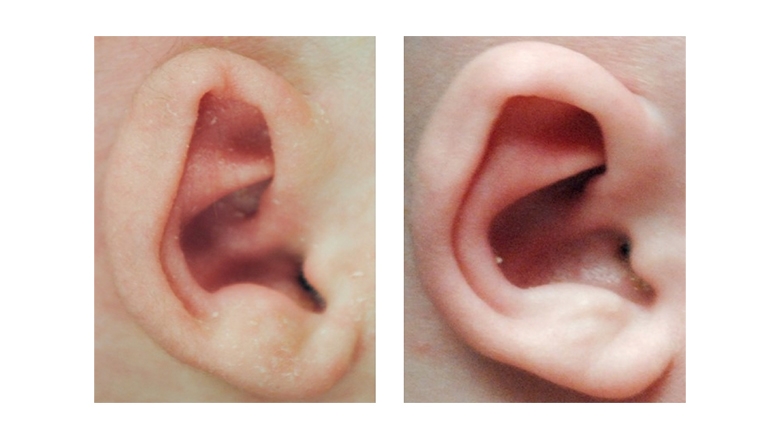 Constricted Ear Deformity before and after Ear Molding