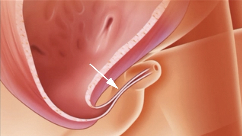 Illustration of triad syndrome, a constricted narrowing in the mid-portion of the urethra
