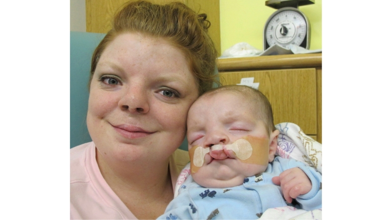 Bilateral Cleft Lip Child and Mom Image