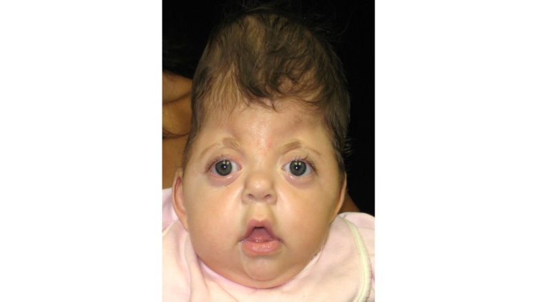 Aperts Syndrome Image
