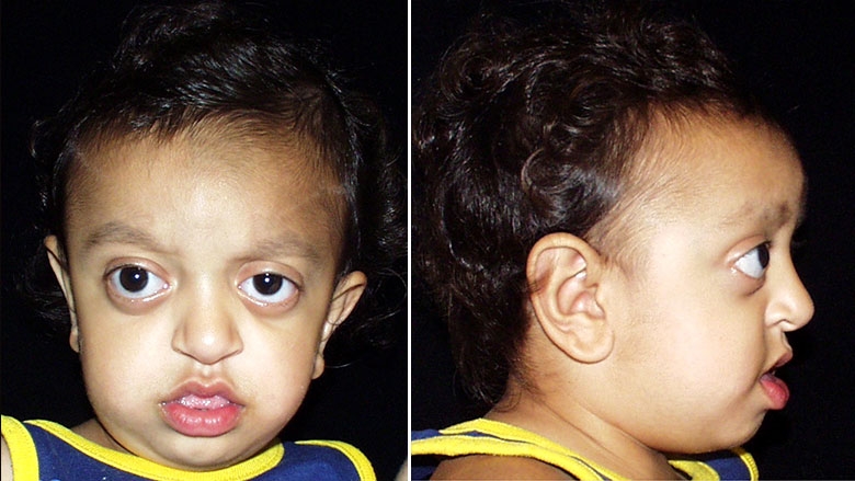18 month old with Crouzon syndrome
