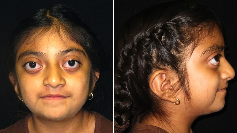 6 year old with Crouzon syndrom