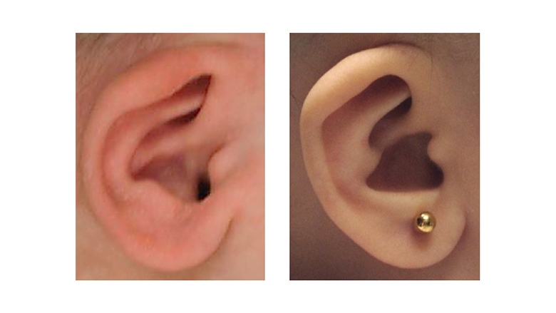 Cryptotia Ear Deformity before and after Ear Molding