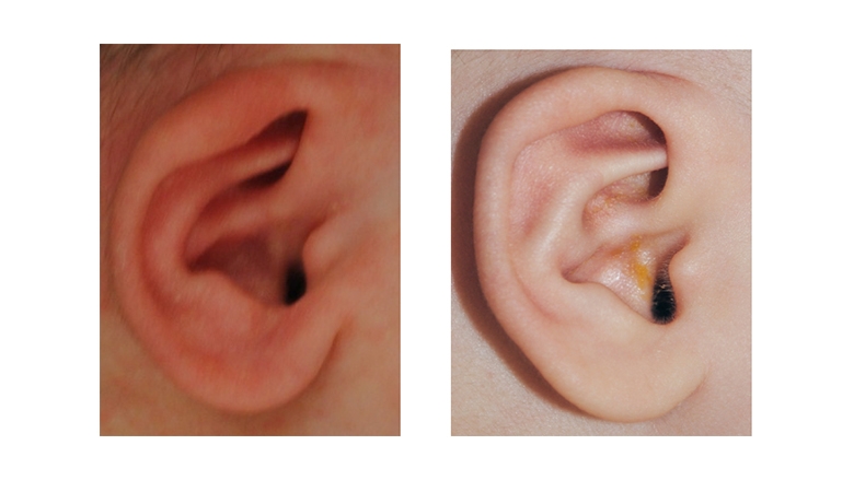 Cryptotia Ear Deformity before and after Ear Molding