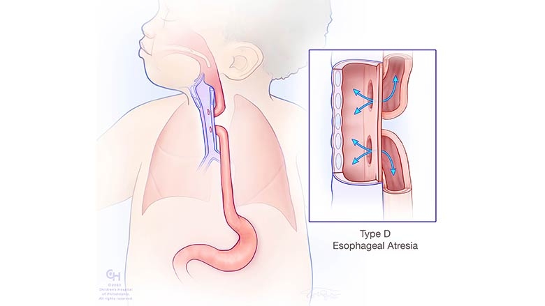 Esophageal Atresia and Tracheoesophageal Fistula (EA/TEF)