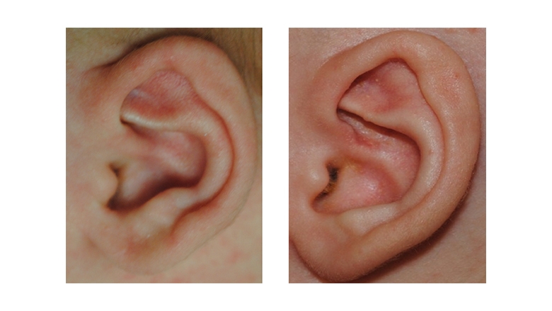 Helical Rim Deformity before and after Ear Molding