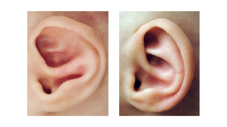 Constricted Ear Deformity before and after Ear Molding