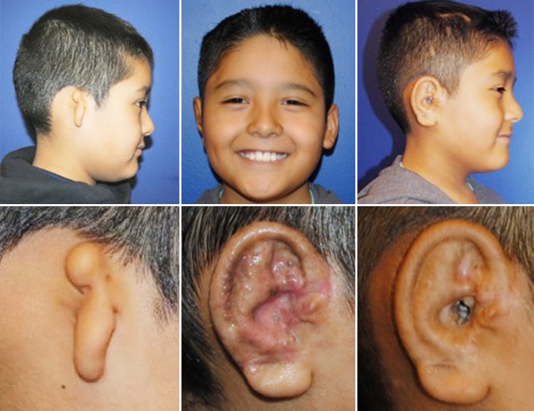 Ear before and after ear reconstruction
