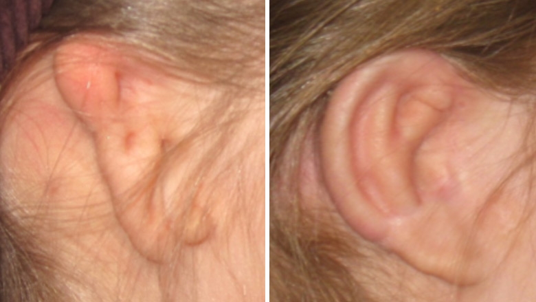 Microtia of the right ear before and after ear reconstruction surgery using rib cartilage