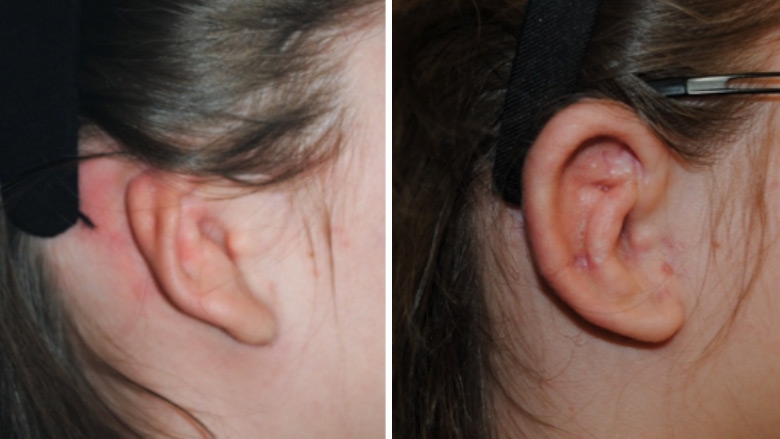 Side view of patient with right microtia, before and after ear reconstruction surgery using rib cartilage. Note ear projection and ability to wear eyeglasses.
