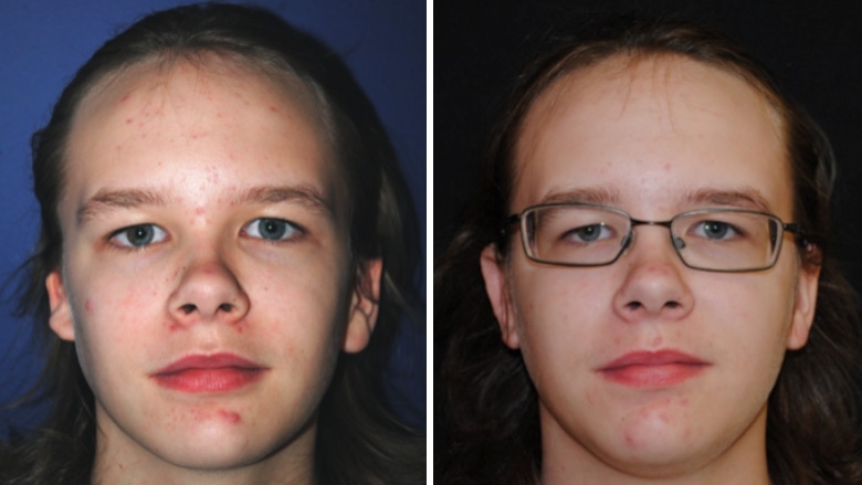 Front view of patient with right microtia, before and after ear reconstruction surgery using rib cartilage. Note ear projection and ability to wear eyeglasses.
