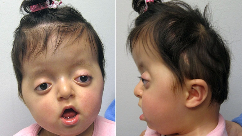 6 month old with Pfieffer syndrome
