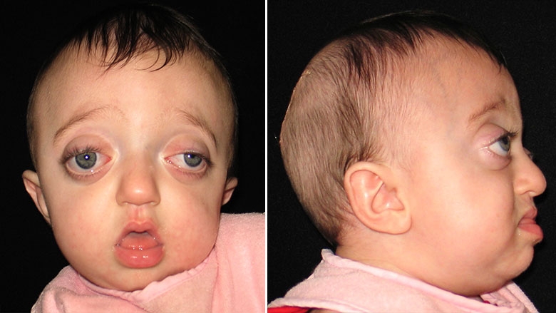 8 month old with Pfieffer Syndrome