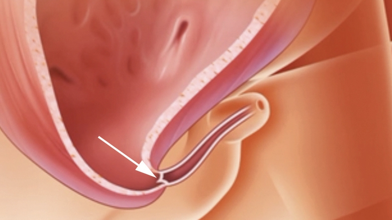 Illustration of posterior urethral valves (PUV), a form of LUTO