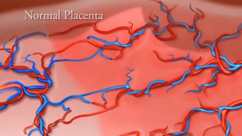 sIUGR normal placenta illustration