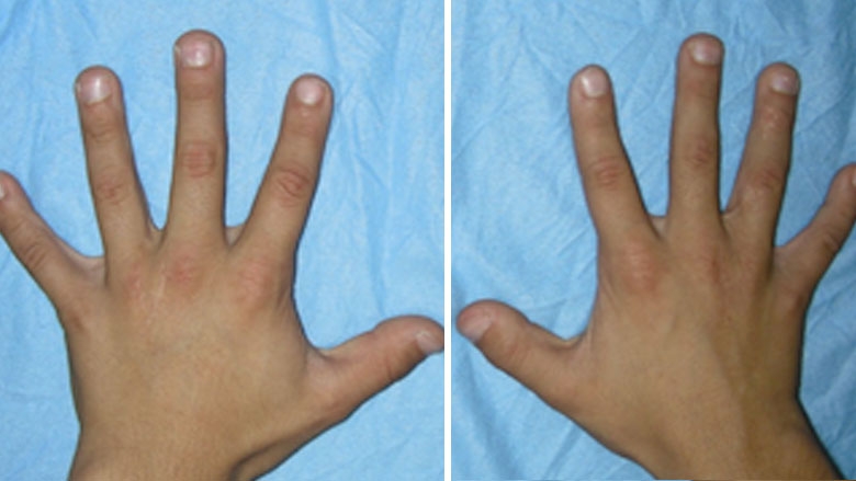 Simple, incomplete syndactyly 8.5 years after surgery 