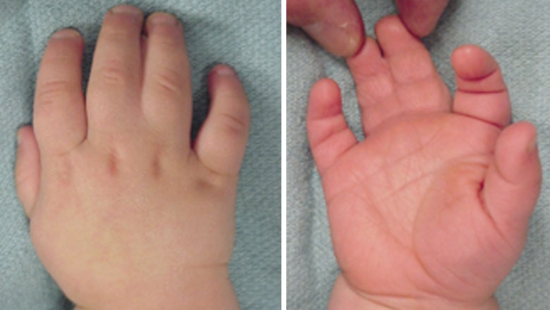 Simple, incomplete syndactyly before surgery