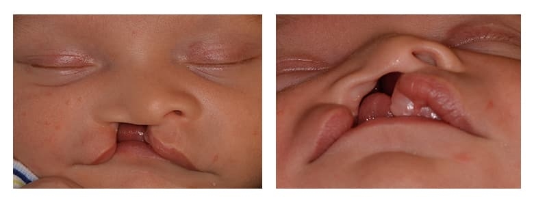 Patient with unilateral complete cleft lip and palate before NAM