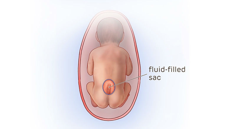Illustration of a fetus with exposed fluid filled sac in preparation for fetal surgery.