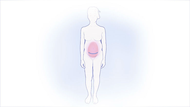 Illustration of mother with uterus incision
