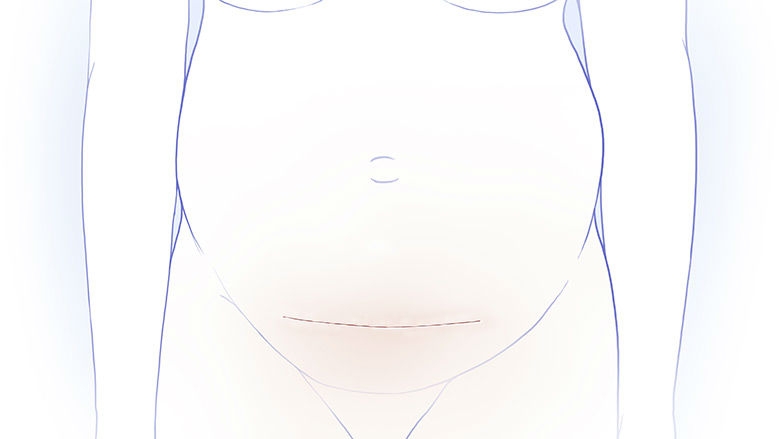Illustration of abdomen closure