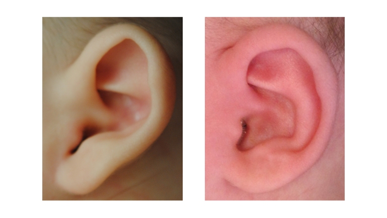 Stahl's Ear Deformity before and after Ear Molding