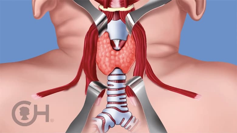 Illustration of thyroid surgery with thyroid exposed