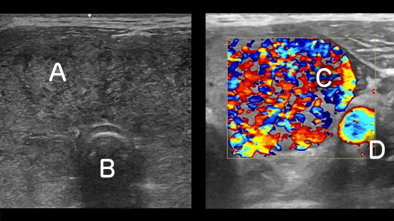 Thyroid ultrasound showing Graves disease on doppler