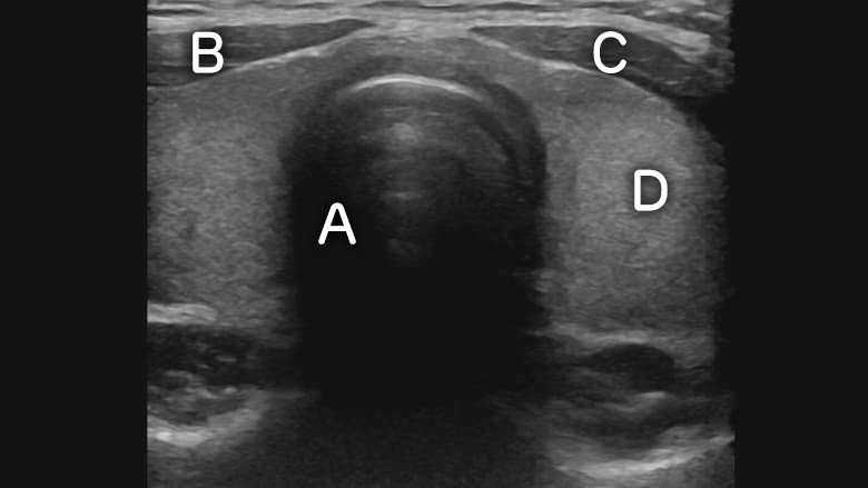 Thyroid ultrasound of a normal thyroid
