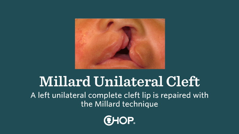 Millard Cleft Lip Slide 1