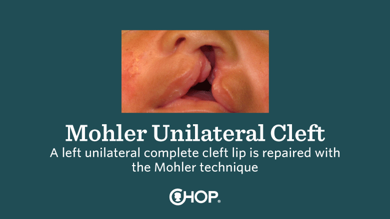 Mohler Cleft Lip Slide 1