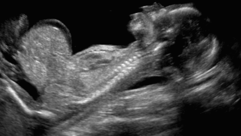 fetal ultrasound omphalocele