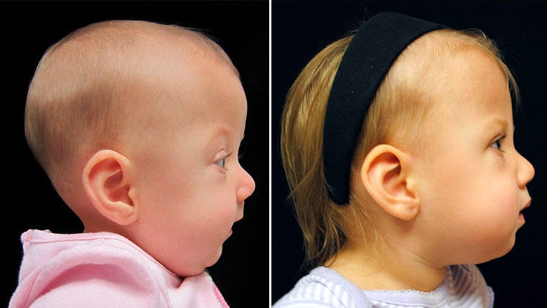 Side by side profile images of pre-operative and post-operative unicoronal synostosis